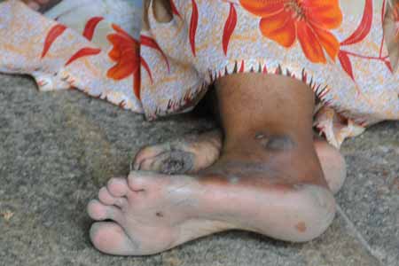 Indien Tiruchirappalli - Sri-Ranganathaswamy-Tempel - kranker Fuß einer Frau